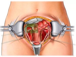 Операция полостная по удалению кисты яичника