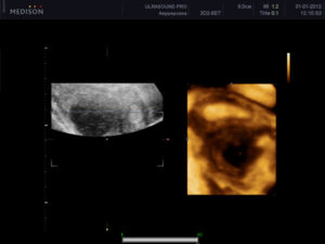 Киста яичника при беременности на ранних сроках