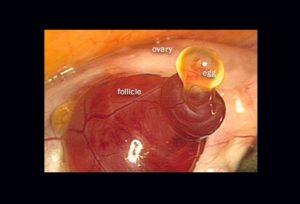 Не выходит яйцеклетка из яичника причины