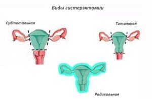 Нужно ли принимать гормоны после удаления матки и яичников