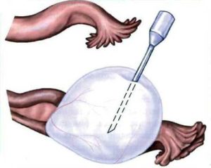 Кульдоцентез при кисте яичника