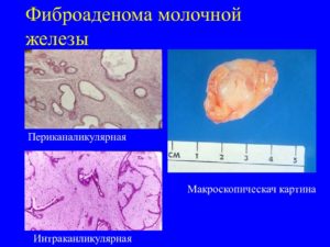 Психосоматика фиброаденома молочной железы