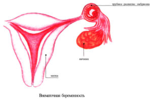 Беременность с одним яичником и одной трубой