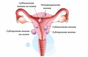 Миома интрамуральная и беременность