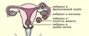 На ранних сроках беременности тянет правый яичник
