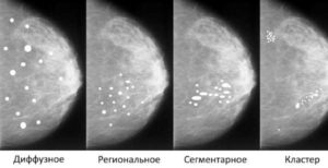 Кальцинаты в молочной железе лечение народными средствами