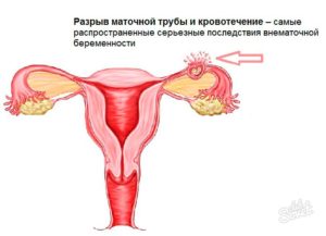 Беременность с одним яичником и одной трубой