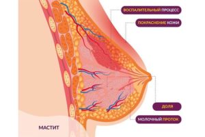 Воспаление протока молочной железы