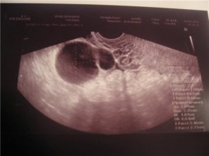 Желтое тело в левом яичнике при беременности на ранних сроках