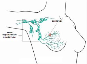 Лимфоузлы в молочной железе