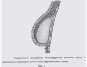 Реконструкция молочной железы