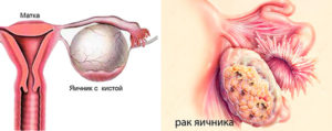 Киста опухоль яичника