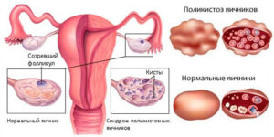 Лечение поликистоза яичников без гормонов