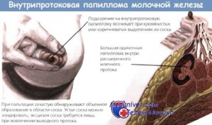 Жидкость из молочных желез при надавливании причины