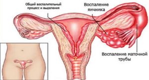 При воспалении яичников могут быть месячные