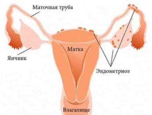 Менструация при эндометриозе