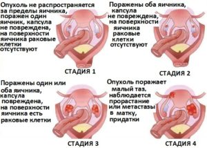 Рак яичников стадии симптомы