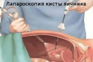 На какой день выписывают после лапароскопии кисты яичника