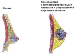 Гипертрофия молочных желез