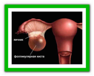 Фолликулярная киста яичника лечение народными средствами