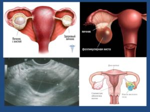 Кистозное образование левого яичника что это такое