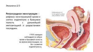 Эндометриоз брюшной полости