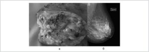 Рак молочной железы сколько живут после операции