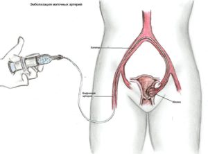 Эмболизация миомы