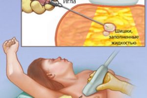 Биопсия фиброаденомы молочной железы