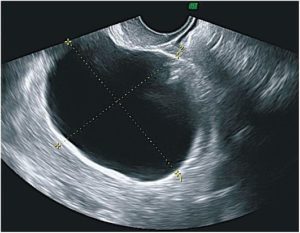Простая серозная киста яичника