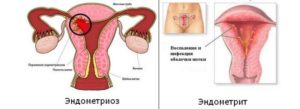 Чем опасен эндометриоз матки