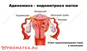 Внутренний эндометриоз матки