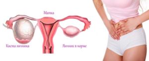 Жжение в области яичников у женщин