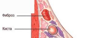 Болит молочная железа при надавливании сбоку