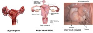 Эндометриоз тела матки что это