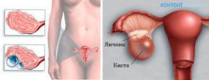 Киста яичника симптомы и лечение женщины народными средствами