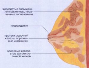 Затвердела молочная железа у кормящей что делать