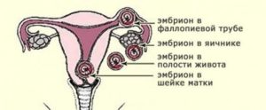 Покалывает яичник при беременности на ранних сроках