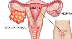 Признаки рака матки и яичников на ранних стадиях