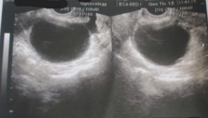 Эхонегативное образование в яичнике