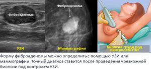 Как удаляют фиброаденому молочной железы