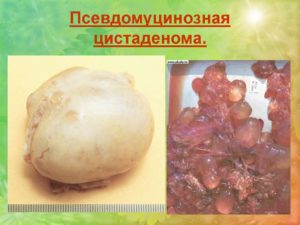 Муцинозная опухоль яичника