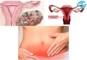 Как болят яичники у женщин симптомы после 40 лет