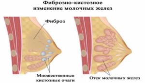 В молочных железах фиброзные изменения