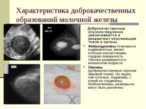 Доброкачественные образования молочной железы