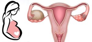 Как беременность влияет на эндометриоз