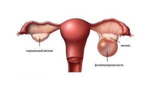 Фолликулярная киста правого яичника можно ли забеременеть