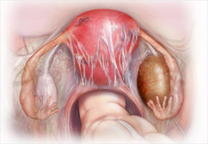 Эндометриоз левого яичника