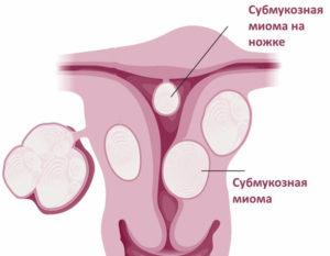 Миома субмукозная