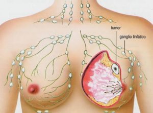 Как выглядит рак молочной железы